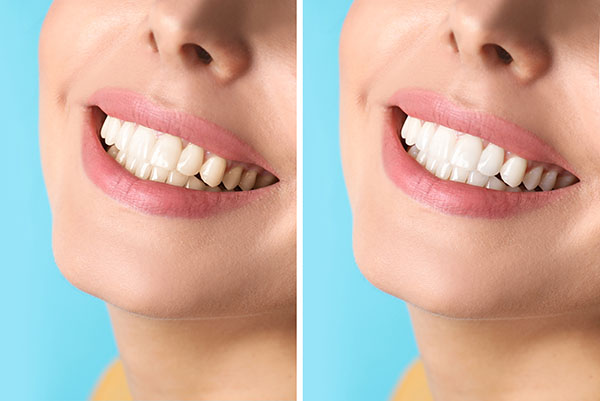 Cosmetic Dental Services With Natural Tooth Color from Total Care Implant Dentistry in Irvine, CA