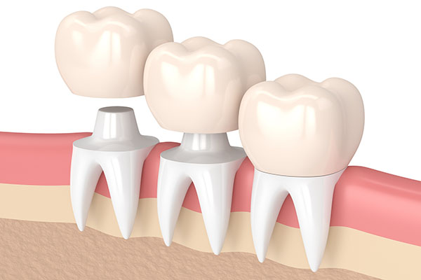 Three Tips to Deal With a Loose Dental Crown from Total Care Implant Dentistry in Irvine, CA