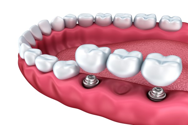 What Are Dental Bridges?