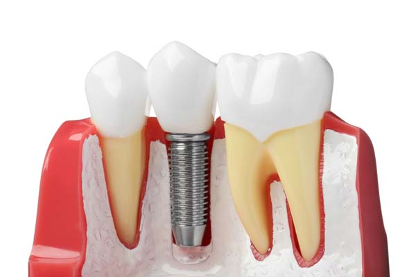 Dental Implant Irvine, CA