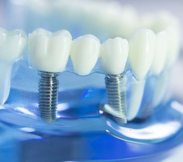 Irvine Dental Implants