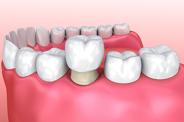How a General Dentist Uses Crowns to Repair Teeth from Total Care Implant Dentistry in Irvine, CA
