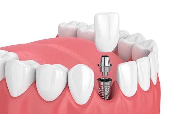 How Painful is Dental Implant Surgery from Total Care Implant Dentistry in Irvine, CA
