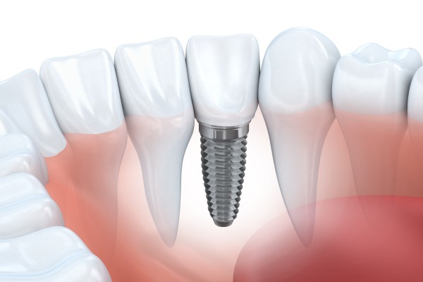Signs You Might Require An Implant Restoration