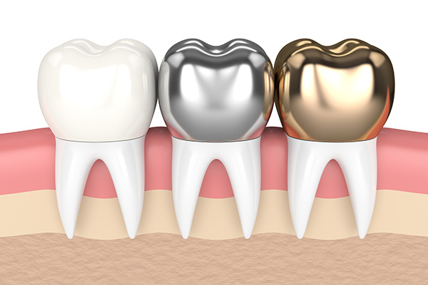Metal Crowns vs. Porcelain Dental Crowns from Total Care Implant Dentistry in Irvine, CA