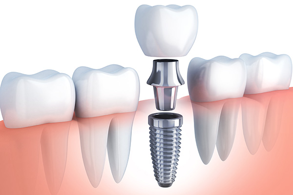 Questions to Ask Your Implant Dentist from Sedation and Implant Dentistry Irvine in Irvine, CA