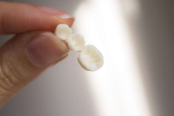 Replace Missing Teeth with Dental Bridges from Total Care Implant Dentistry in Irvine, CA