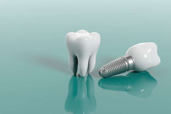 Multiple Teeth Replacement Options: One Implant for Two Teeth from Total Care Implant Dentistry in Irvine, CA